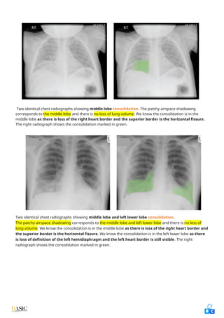 Comprehensive Clinical Guide to Chest X-Ray Interpretation and Anatomy ...
