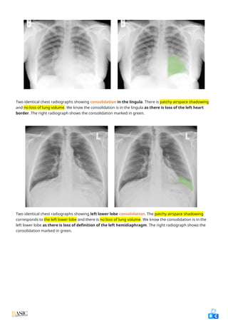 Comprehensive Clinical Guide to Chest X-Ray Interpretation and Anatomy ...