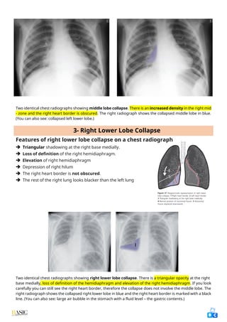 Comprehensive Clinical Guide to Chest X-Ray Interpretation and Anatomy ...
