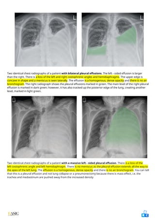 Comprehensive Clinical Guide to Chest X-Ray Interpretation and Anatomy ...