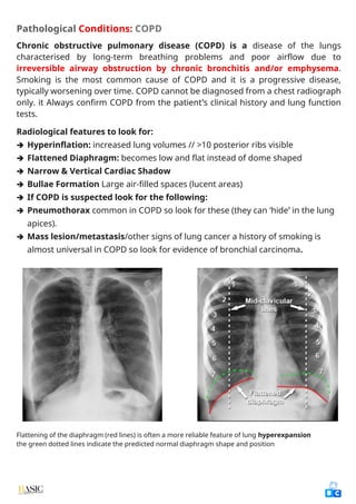Comprehensive Clinical Guide to Chest X-Ray Interpretation and Anatomy ...