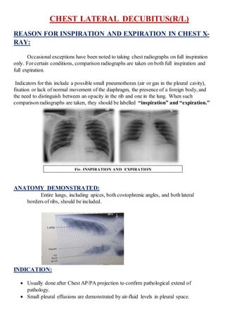 CHEST LATERAL DECUBITUS(R/L)
REASON FOR INSPIRATION AND EXPIRATION IN CHEST X-
RAY:
Occasional exceptions have been noted to taking chest radiographs on full inspiration
only. Forcertain conditions, comparison radiographs are taken on both full inspiration and
full expiration.
Indicators for this include a possible small pneumothorax (air or gas in the pleural cavity),
fixation or lack of normal movement of the diaphragm, the presence of a foreign body, and
the need to distinguish between an opacity in the rib and one in the lung. When such
comparison radiographs are taken, they should be labelled “inspiration” and “expiration.”
ANATOMY DEMONSTRATED:
Entire lungs, including apices, both costophrenic angles, and both lateral
borders of ribs, should be included.
INDICATION:
 Usually done after Chest AP/PA projection to confirm pathological extend of
pathology.
 Small pleural effusions are demonstrated by air-fluid levels in pleural space.
Fig. INSPIRATION AND EXPIRATION
 