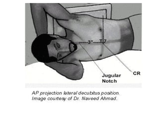 CHEST DECUBITUS VIEW.pptx For chest view | PPTX