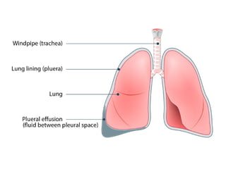 CHEST DECUBITUS VIEW.pptx For chest view | PPTX