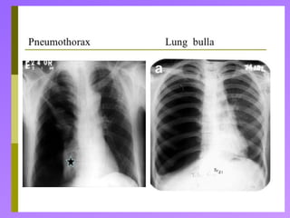 CHEST DRAINS for pleural effusion and also pneumothorax.pptx