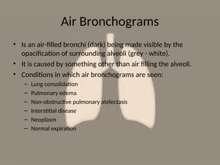 Comprehensive Guide to Chest X-Ray Interpretation and Common Findings | PPT