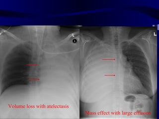 Volume loss with atelectasis
                               Mass effect with large effusion
 