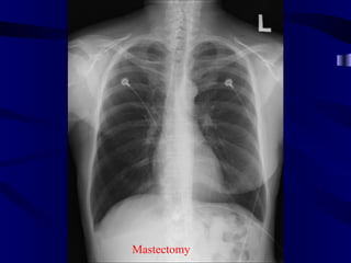 baseline




Mastectomy
 