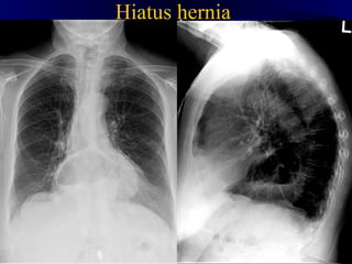 Hiatus hernia
     hh
 