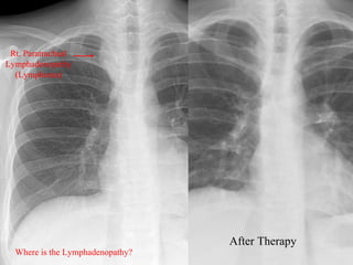 Rt. Paratracheal
Lymphadenopathy
  (Lymphoma)




                                  After Therapy
  Where is the Lymphadenopathy?
 