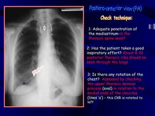 1



                     1: Adequate penetration of
    4
                 a   the mediastinum-is the
             a       thoracic spine seen?

                     2: Has the patient taken a good
                     inspiratory effort? About 8-10
7
                     posterior thoracic ribs should be
                     seen through the lungs


                     3: Is there any rotation of the
                     chest? Assessed by checking
    10               the upper thoracic spinous
                     process (oval) in relation to the
                     medial ends of the clavicles
                     (lines ‘a’) - this CXR is rotated to
                     left
 