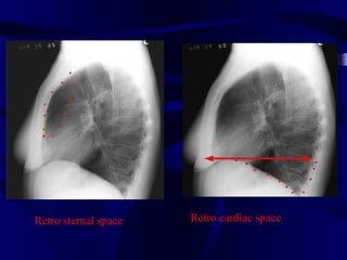 Retro sternal space   Retro cardiac space
 