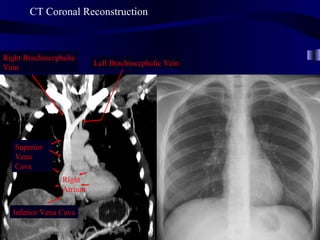 CT Coronal Reconstruction



Right Brachiocephalic
                          Left Brachiocephalic Vein
Vein




   Superior
   Vena
   Cava
                 Right
                 Atrium

  Inferior Vena Cava
 