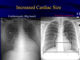 Increased Cardiac Size
                           Normal for comparison
Cardiomegaly (Big heart)
 