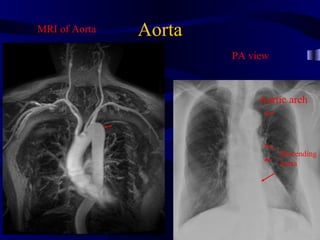 MRI of Aorta   Aorta
                       PA view



                            Aortic arch




                                 Descending
                                 Aorta
 