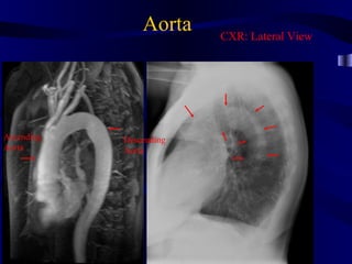 Aorta    CXR: Lateral View




Ascending   Descending
Aorta       Aorta
 