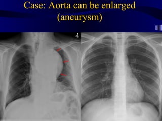 Case: Aorta can be enlarged
       (aneurysm)
 