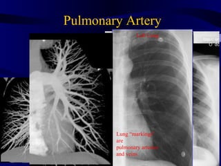 Pulmonary Artery
                           Left Lung




Coronal Image




                                        PA



                   Lung “markings”
                   are
                   pulmonary arteries
                   and veins
 