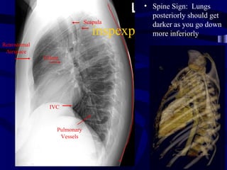 • Spine Sign: Lungs
                                              posteriorly should get
                               Scapula
                                              darker as you go down
                                  inspexp     more inferiorly
Retrosternal
 Airspace
               Hilum




                IVC



                   Pulmonary
                    Vessels
 