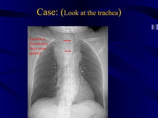 Case: (Look at the trachea)

Trachea is
Deviated by
large mass
(goiter)
 