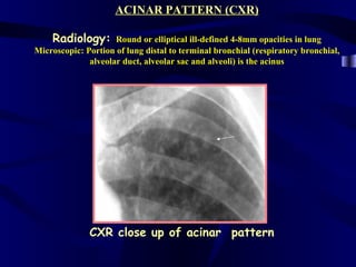 ACINAR PATTERN (CXR)

    Radiology:       Round or elliptical ill-defined 4-8mm opacities in lung
Microscopic: Portion of lung distal to terminal bronchial (respiratory bronchial,
              alveolar duct, alveolar sac and alveoli) is the acinus




              CXR close up of acinar pattern
 