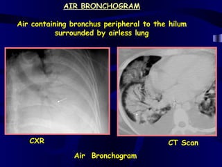 AIR BRONCHOGRAM

Air containing bronchus peripheral to the hilum
           surrounded by airless lung




   CXR                                   CT Scan
               Air Bronchogram
 