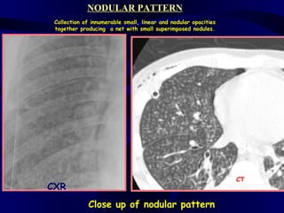 NODULAR PATTERN
 Collection of innumerable small, linear and nodular opacities
 together producing a net with small superimposed nodules.




                                                                 CT
CXR
             Close up of nodular pattern
 