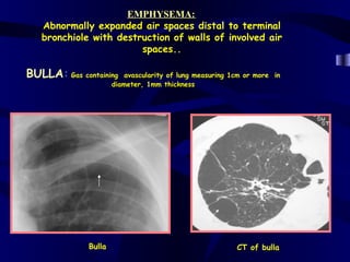 EMPHYSEMA:
   Abnormally expanded air spaces distal to terminal
   bronchiole with destruction of walls of involved air
                        spaces..

BULLA: Gas containing     avascularity of lung measuring 1cm or more in
                      diameter, 1mm thickness




              Bulla                                       CT of bulla
 