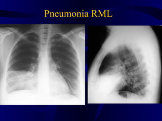 Pneumonia RML
 