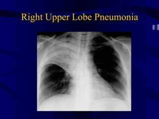 Right Upper Lobe Pneumonia
 