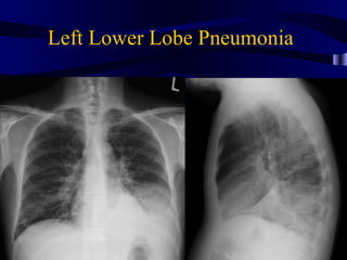 Left Lower Lobe Pneumonia
 