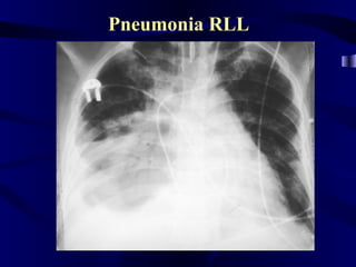 Pneumonia RLL
 
