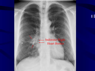 Indistinct Right
  Heart Border
 