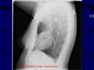 Right Middle Lobe Atelectasis
 