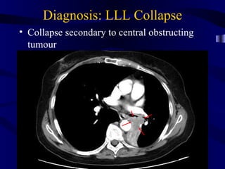Diagnosis: LLL Collapse
• Collapse secondary to central obstructing
  tumour
 