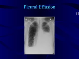 Pleural Effusion
 