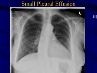 Small Pleural Effusion
 