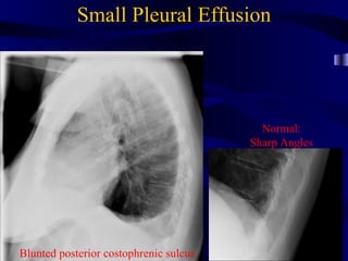 Small Pleural Effusion




                                          Normal:
                                        Sharp Angles




Blunted posterior costophrenic sulcus
 