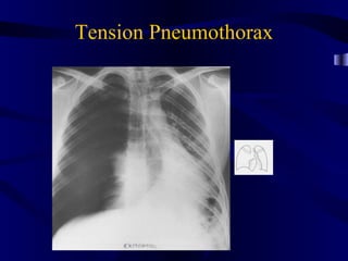 Tension Pneumothorax
 