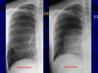 ptxinspexp




Inspiration                Expiration
 