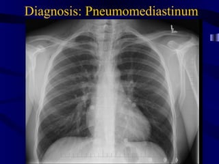 Diagnosis: Pneumomediastinum
 