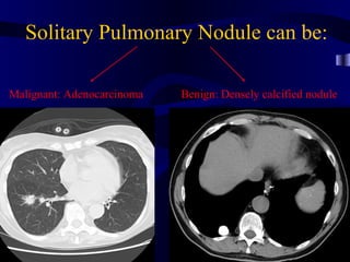 Solitary Pulmonary Nodule can be:

Malignant: Adenocarcinoma   Benign: Densely calcified nodule
 