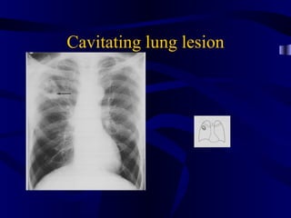 Cavitating lung lesion
 