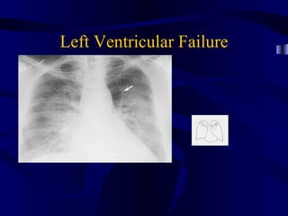 Left Ventricular Failure
 