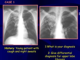 CASE 1




                              1:What is your diagnosis
History: Young patient with
  cough and night sweats
                                2: Give differential
                              diagnosis for upper lobe
 
