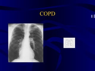 COPD
 