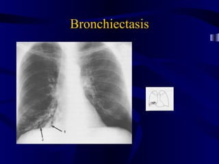 Bronchiectasis
 