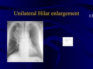 Unilateral Hilar enlargement
 