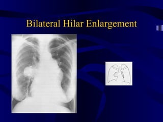 Bilateral Hilar Enlargement
 
