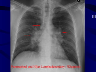 Paratracheal and Hilar Lymphadenopathy: ?Diagnosis
 